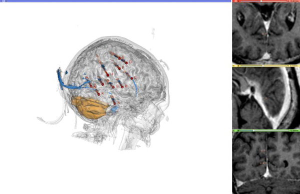 Implantación de electrodos profundos mediante la metodología de SEEG (stereoelectroencefalografía